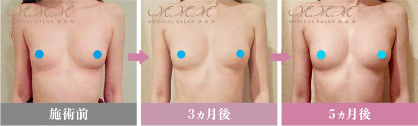 バストアップ症例紹介